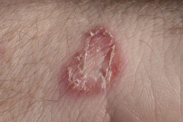 Red itchy rash skin fungus
